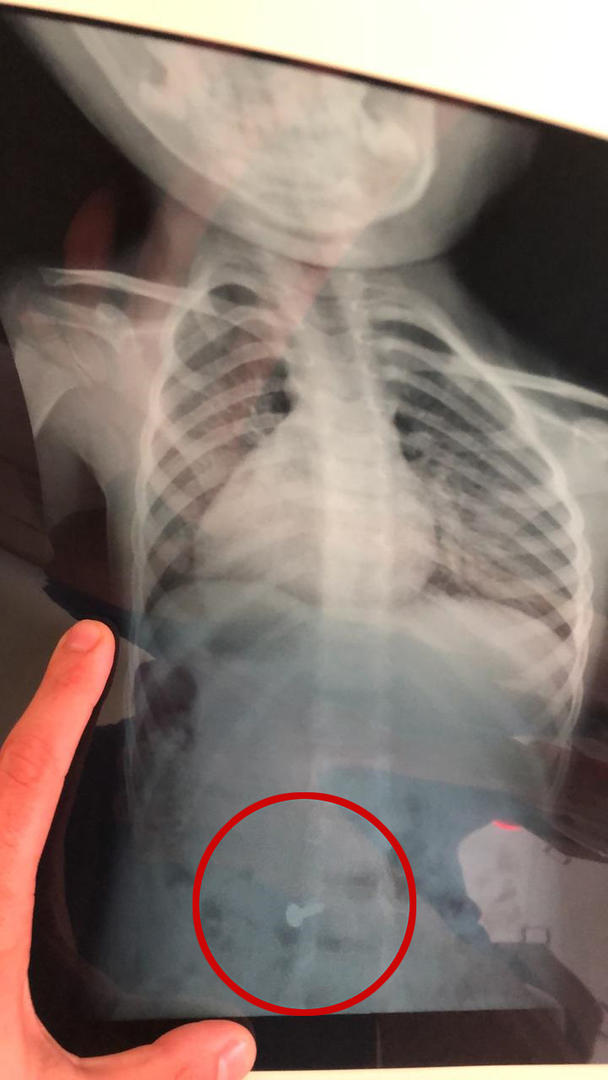 SUSTO. La radiografía de Maitena mostró que se había tragado un tornillo. Por suerte pasó rápido el esófago y luego lo despidió.