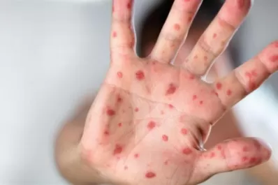 Tucumán ya colocó en 2022 más de 70.000 vacunas contra el sarampión y la rubéola