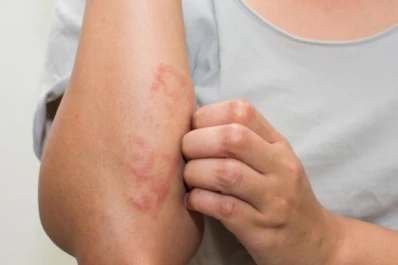 Psoriasis: “un paciente informado es un paciente empoderado”