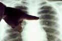 Cáncer de pulmón: qué pacientes responden a la inmunoterapia