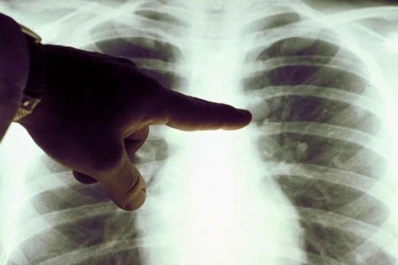 Cáncer de pulmón: qué pacientes responden a la inmunoterapia