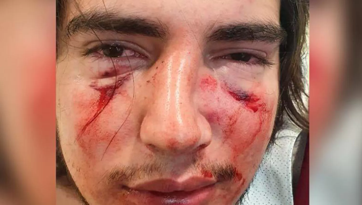 LA VÍCTIMA. Lautaro Insúa recibió golpes de puño en la cara y patadas cuando cayó al piso.