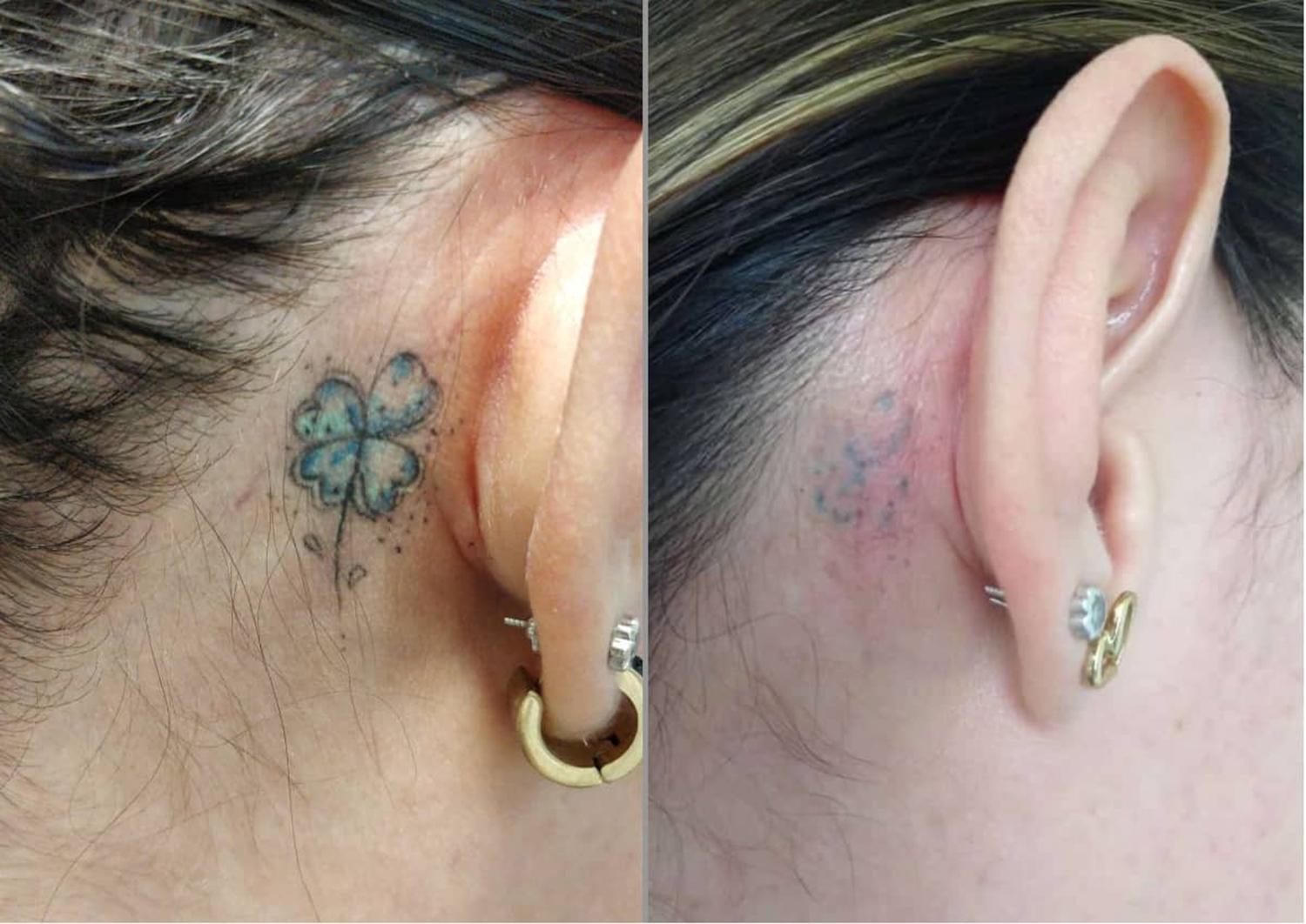 Diferentes opciones para borrar ese tatuaje que ya no querés
