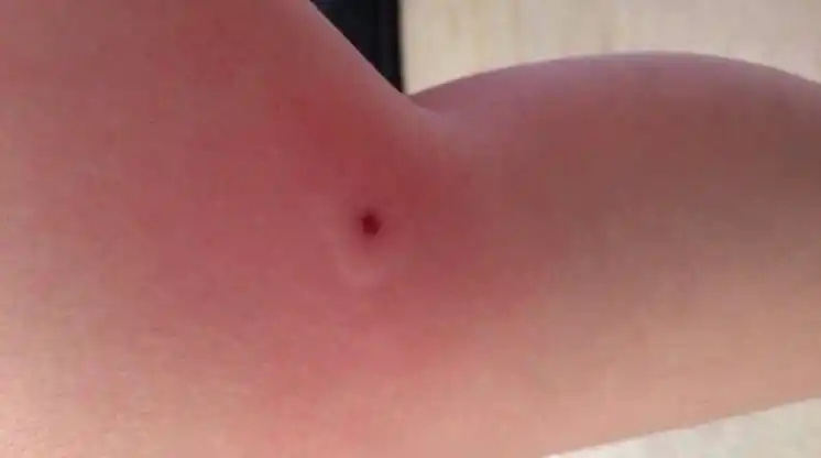 Los mosquitos, un dolor de cabeza para los tucumanos: para qué sirve cada repelente