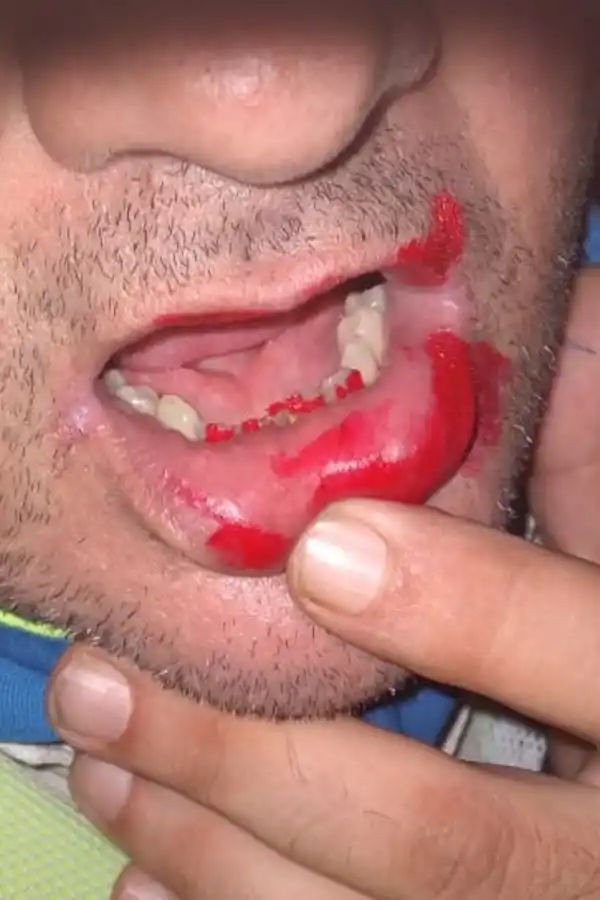 LESIONES. El agente Sacrispanti denuncia que sufrió un golpe en el rostro. 