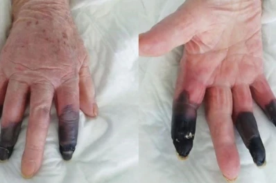 Covid-19: le amputan tres dedos tras desarrollar una inesperada gangrena