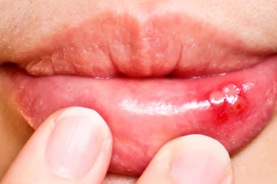 Aftas bucales: todo lo que tenés que saber para prevenirlas y tratarlas cuando aparecen