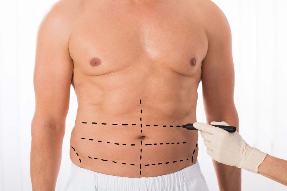 HOMBRES. Sus consultas son por calvicie, adiposidad mamaria y las bolsas de grasa que aparecen bajo los ojos. 