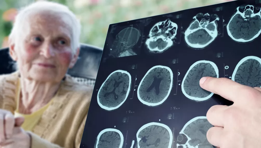 AVANCE. Recientemente, Estados Unidos aprobó el primer fármaco nuevo contra el alzheimer en casi dos décadas. ARCHIVO LA GACETA