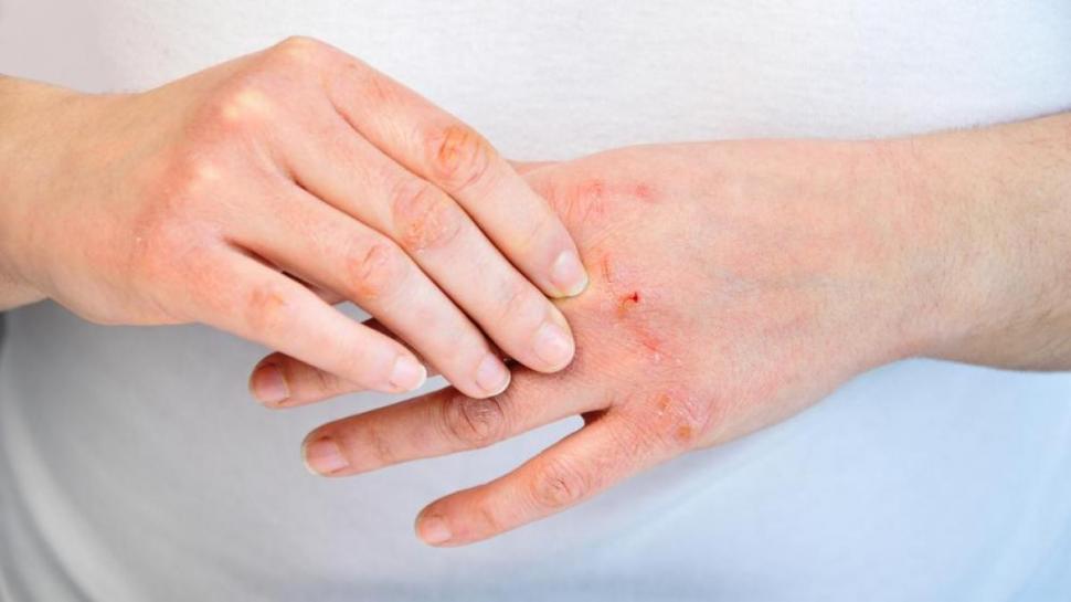 MANOS. Puede aparecer una dermatitis por su desinfección constante. 
