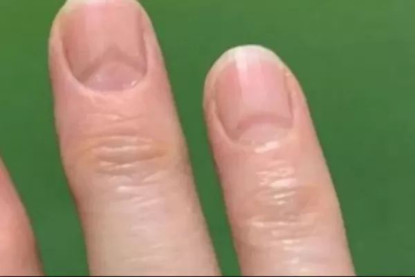 El coronavirus deja huellas en las uñas, según la ciencia: cuáles son esas marcas