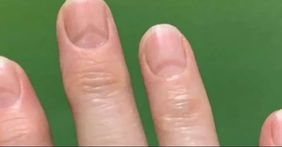 El coronavirus deja huellas en las uñas, según la ciencia: cuáles son esas marcas