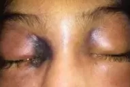 Coronavirus: se registra la primera muerte por “hongo negro” en la Argentina