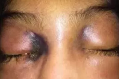 Bolivia confirmó el primer caso de hongo negro en un paciente recuperado de coronavirus