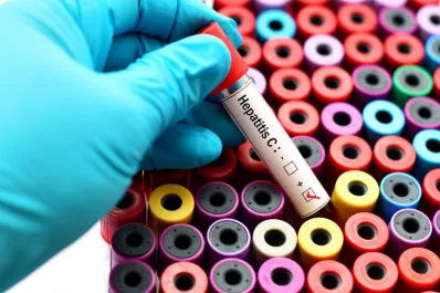 Día Mundial: Prevenir y detectar rápido, las claves para acabar con las hepatitis virales