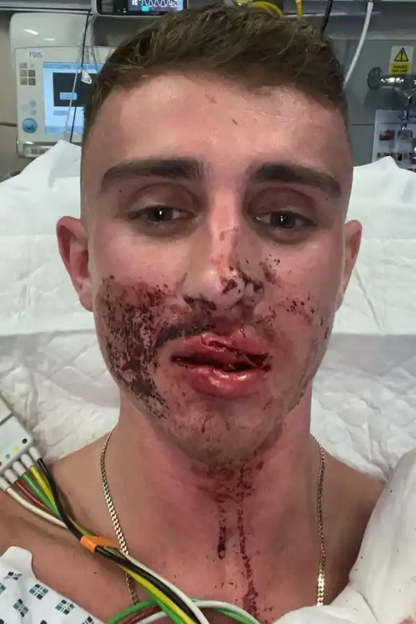 Atacaron a un taekwondista irlandés y tuvieron que hacerle una reconstrucción facial