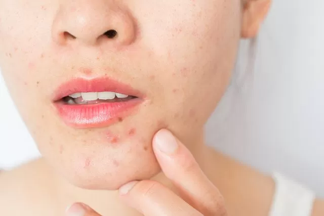 INDICACIONES. Los especialistas recomiendan utilizar productos de limpieza aptos para pieles acneicas y evitar pinchar o apretar las lesiones. 