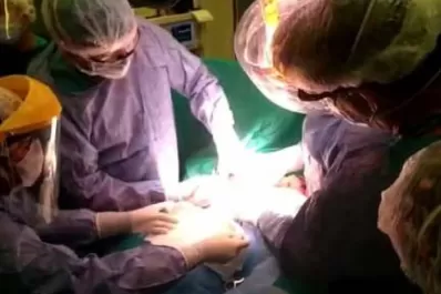 Primera cirugía de tumor en lengua en un bebé que estaba en el vientre de su madre