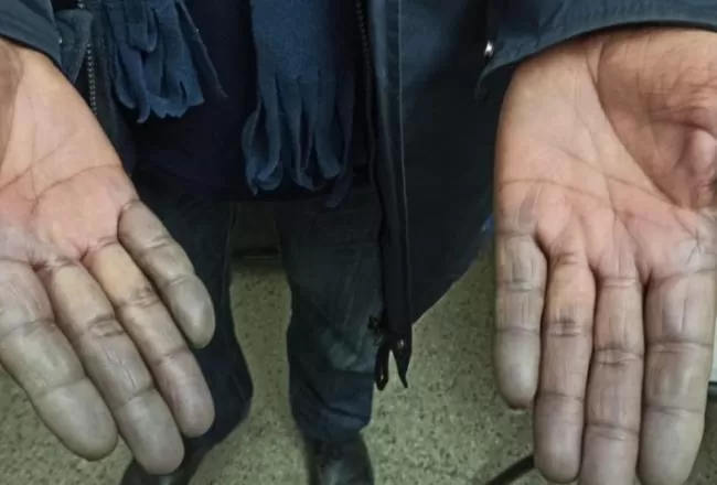 Dedos azules: conocé en qué consiste este fenómeno que afecta a cientos de tucumanos