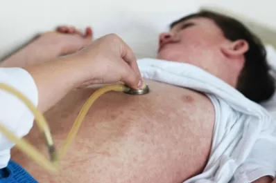 Detectaron un caso probable de sarampión en la Ciudad de Buenos Aires