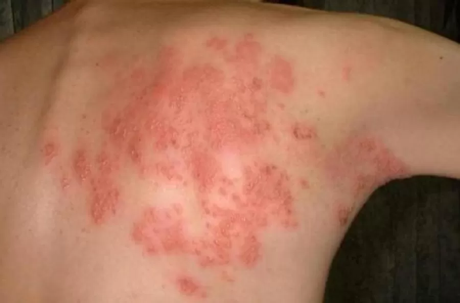 Una especialista tucumana derriba mitos sobre el Herpes zoster o culebrilla