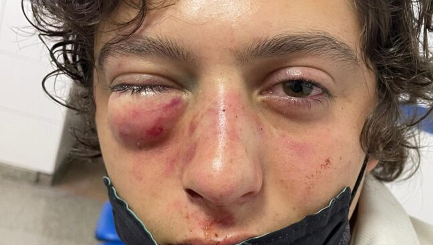FRACTURAS. Oscar Colombres tiene 19 años y sufrió lesiones en la nariz y en el piso de órbita de su ojo derecho..