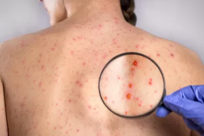 Tucumán lanza la campaña de vacunación Doble Viral contra el sarampión y la rubeola