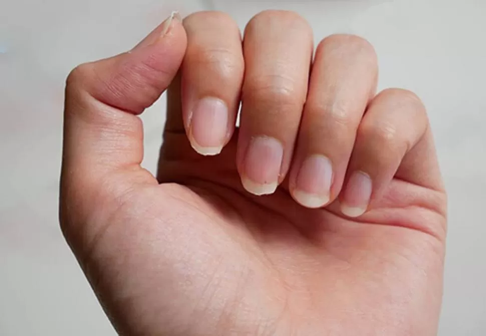 EL PRIMER PASO. El tratamiento comienza identificando las causas. Después, el cuidado sigue hasta que se logra superar la fragilidad de las uñas. 