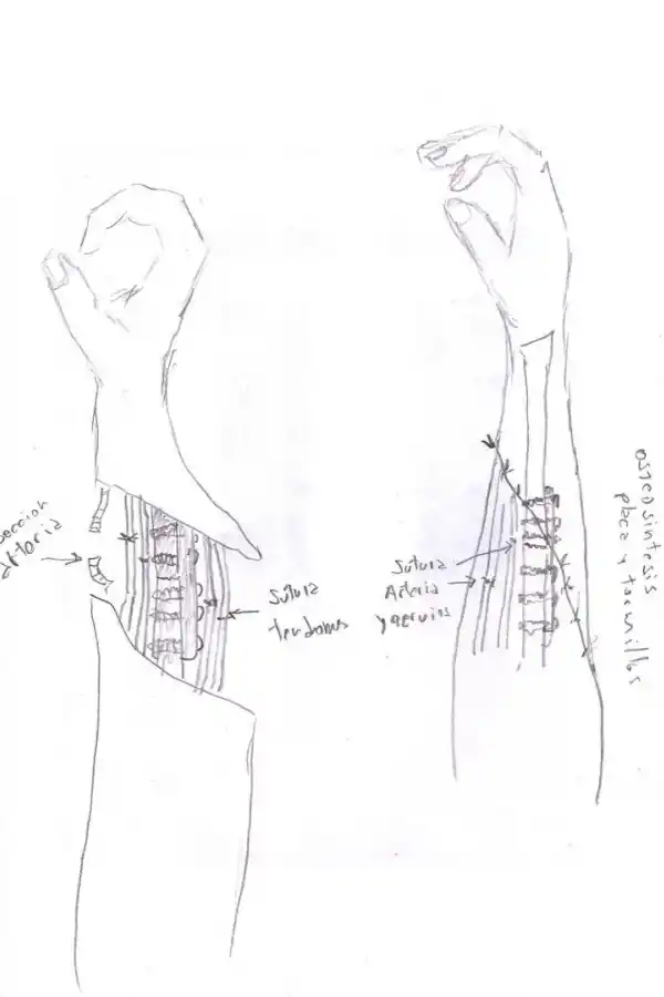 EL REIMPLANTE. Los dibujos a mano alzada del doctor Urpi mostraron con precisión el lugar donde fueron los cortes en el accidente. 