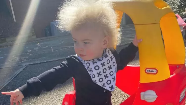 PATOLOGÍA. Tiene 16 meses y padece el síndrome del cabello impeinable.
