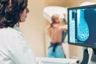 En 2020 se detectaron 22.000 casos de cáncer de mama