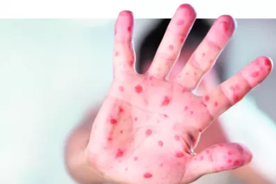 Confirman un caso de sarampión importado en la Ciudad de Buenos Aires