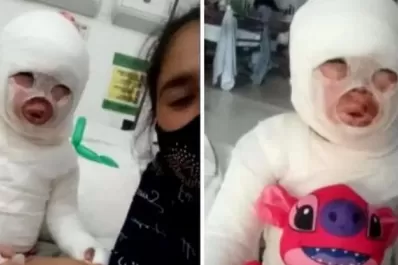 Quemaron con aceite hirviendo a una nena de tres años en un restaurante