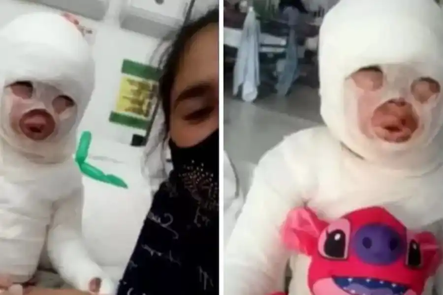 Briana tiene el 54% del cuerpo quemado luego de que una olla de aceite caliente cayera sobre ella