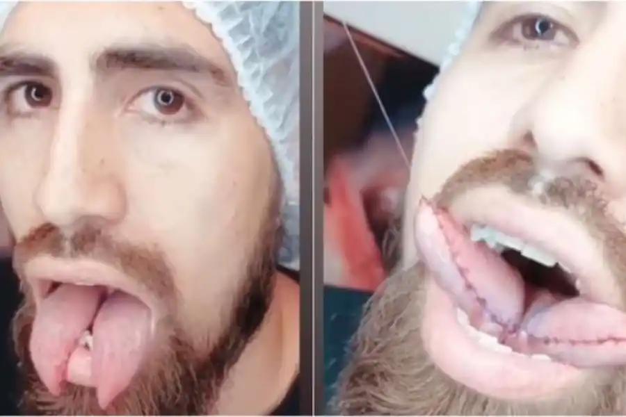 El después: Benítez muestra su lengua tras la operación.