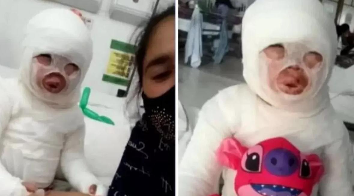 Briana tiene el 54% del cuerpo quemado luego de que una olla de aceite caliente cayera sobre ella