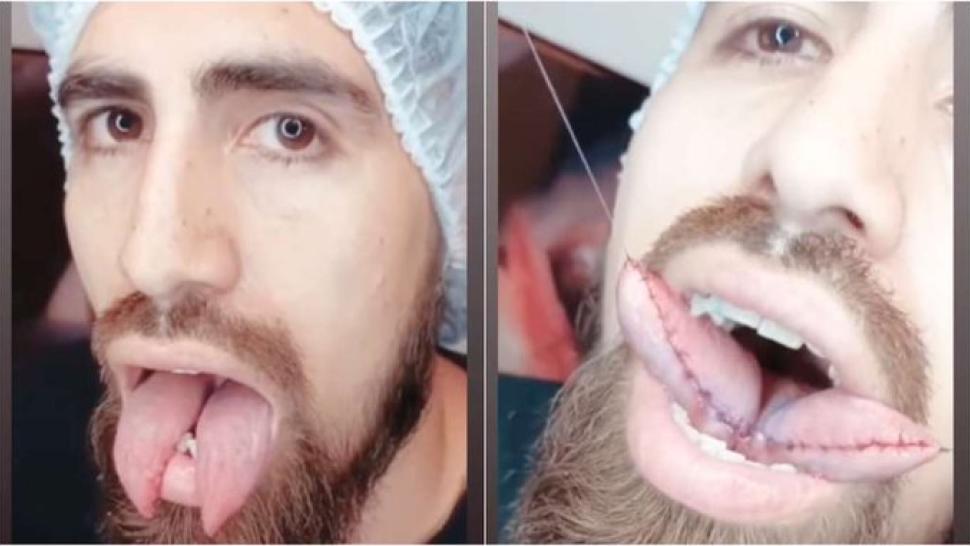 El después: Benítez muestra su lengua tras la operación.