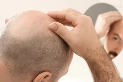 Polémica en Reino Unido: un tribunal dictaminó que llamar a un hombre calvo es acoso sexual