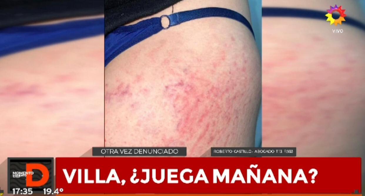La foto que presentó la ex pareja de Villa con las heridas que provocó el ataque denunciado.