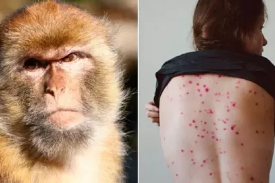 Quiénes corren más riesgo de contagiarse la viruela del mono