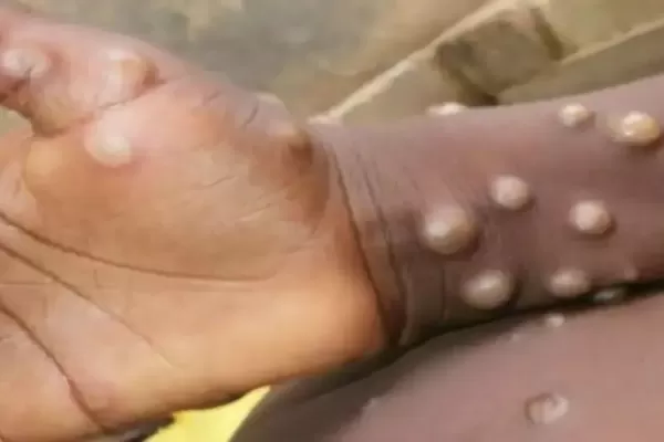 Detectan el primer caso de viruela del mono en México