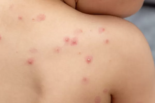 Viruela del mono: ya se detectaron 40 casos en España