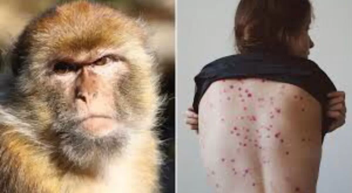 Viruela del mono: el paciente argentino continúa mejorando