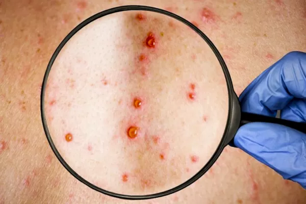 Brasil registra el primer caso de viruela del mono en San Pablo
