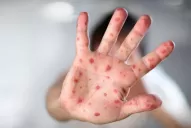 Viruela del mono: Países Bajos comenzó a vacunar a su población