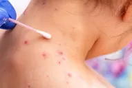 Aprueban una vacuna contra la viruela del mono: cómo es y quién la produce