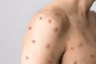 Viruela del mono: España superó los 5.000 casos