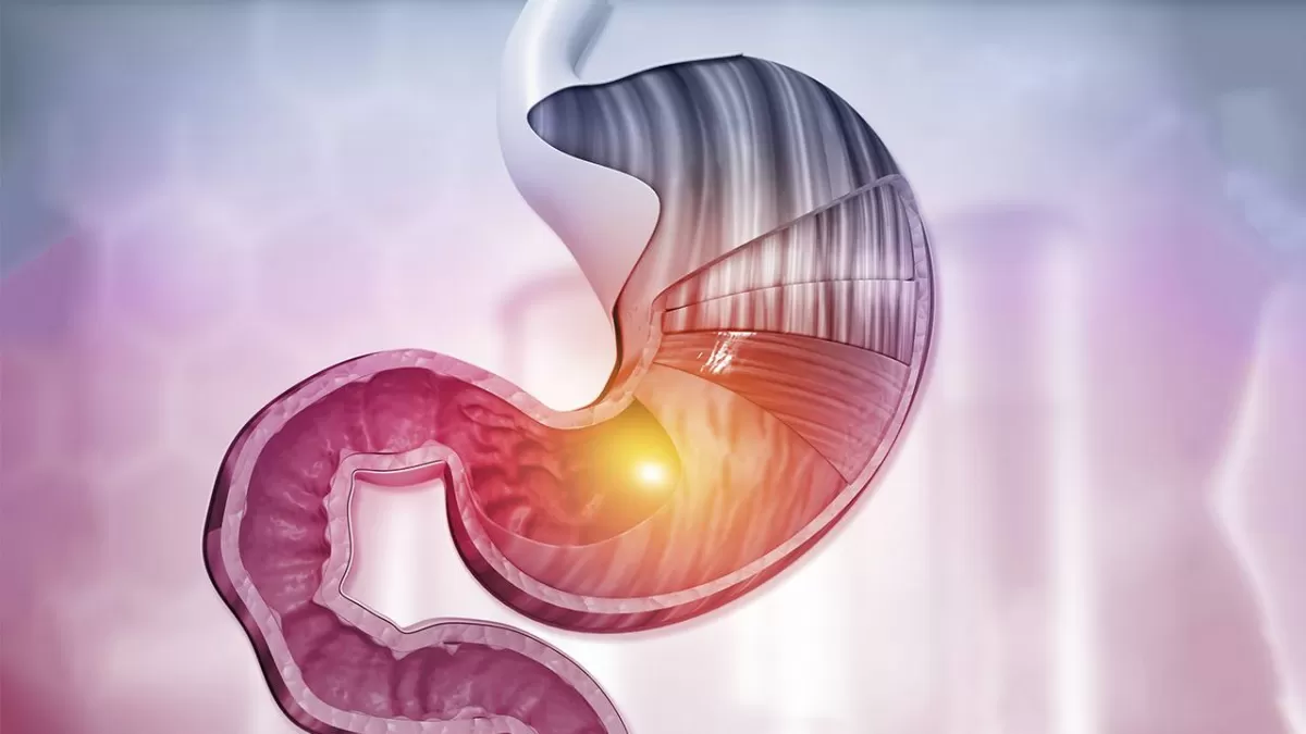 No subestimes la acidez estomacal: un gastroenterólogo tucumano te explica por qué