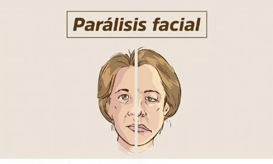 Neuróloga tucumana explica todo sobre parálisis facial
