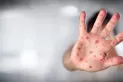 Alarma mundial por una nueva enfermedad:  la “gripe del tomate”, que se manifiesta con grandes ampollas